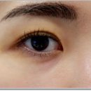 강남미의원 | 강남역미의원 지인추천으로 다녀왔어욧 애교필러 후기!