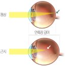 FLEX PC | SWISS FLEX 4050 C50 + HOYA 마이오스마트 근시 억제 렌즈 후기