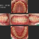 탑플란트 치과의원 | 성남 분당치과 삐뚠 앞니 성인 부분교정 실제후기 1