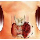 갑상선암증상 "목소리가 이상해요" 이미지