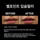 벨포인트의원 네이버블로그