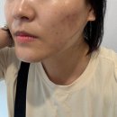 이수 본점 재방문 에스테인 페이스핏톡스 받고 피부 정돈된 내돈내산 후기 사당 피부샵, 이수역 피부관리