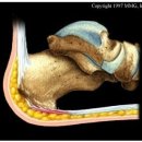 족저 근막염 치료법 이미지