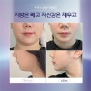 포인트성형외과의원 | 2025 얼굴지방흡입 가격 완전정리 / 비용 · 후기 · 체크포인트[프레쉬홍닥터의원] - 구.프레쉬성형외과