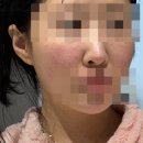 정도 | [서울/명동] 나비존 피코프락셀 통증 강도 정도 내돈내산 후기