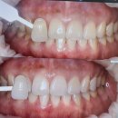 강남드림 | [강남] 화이트드림 강남점 치아 미백 솔직후기