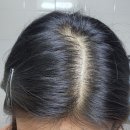 다정약국 | 바르는 미녹시딜 9개월 내돈내산 후기 (혹 떼려다 혹 붙인 이야기) 부작용 쉐딩현상 로게인폼 마이녹실...