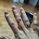 대전화병원 | 대전 화상병원 24시간 응급실 다녀온 후기 ㅠㅠ (feat. 대전화병원)