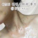 서울랩파트너스 | 내돈내산 편사제거후기ㅣ서울 강남 편평사마귀 제거 얼굴 목 무제한 제거 이벤트