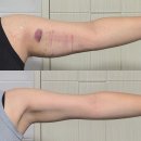 러러 | [무한람스.8] 내돈내산 팔뚝 무한람스 + 부유방 제거 지속적인 변화 솔직후기 (3개월 경과)