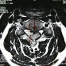 경추디스크치료사례-4경추4-5번간 추간판 탈출증 하*순님 여자/47세 치료전-후MRI비교 이미지