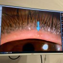 부평형제점 | 부평 글로벌비젼 안과 안구건조증 마이봄샘 레이저치료 후기