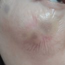 안성리-7 | 흑자제거