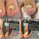 은평구 내성발톱으로 고통받는다면? 통증 없는 전문 교정관리 아델리오 네일&amp;문제성손발톱 응암역촌점