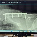 고려보조기 | 쇄골 골절 수술 후기 (수술 비용, 입원기간, 회복기간, 보조기 착용 기간, 재활운동, 완치기간, 병원...