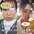 바디라인 | 노원피부과 온다리프팅 / 브이올렛 / 보톡스 내돈내산 솔직후기