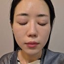 해뜨는댕 | 옥정동피부과에서 고현정리프팅 텐써마 후기, 정품 팁 확인했어요