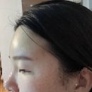 송강하나의원 | 필러 큐오필 쁘띠2.7의원:) 내돈내산 처음 필러 맞는...얼마나 아플까 (긴글주의)9일후 후기있어요!!