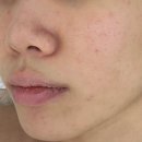 건성(주) | 동대문구 피부관리실 노메러스킨 :: 여드름 건성 케어 (내돈내산 10회 후기)