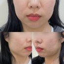 V-3 | 강남 얼굴지방분해주사 갸름주사 V라인주사 내돈내산 후기(+당일, 3일차 후기)