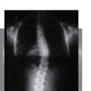 척추 측만증 조기 발견과 조기치료가 ~~~~ 이미지