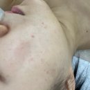노메러 | 동대문구 외대역 제대로 된 트러블 관리 받고 온 후기 [노메러 스킨] 에스테틱 추천