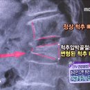 골다공증 심해지면 척추압박골절 이미지