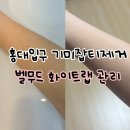 작은팔 | 홍대입구역 기미잡티제거 벨무드 팔잡티 솔직후기