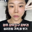 나잡아바라 | 광주 상무지구 피부과 볼륨 실리프팅 가격,멍 붓기 리얼후기!!