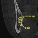 노원플러스치과의원 | 노원치과 복잡한 매복사랑니 발치 가능할까?