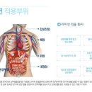 리미션 고주파 온열 암치료법 소개 이미지