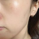 바른치킨 화정점 | 광주피부관리 핫뷰티에서 미백 톤업관리