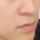 명동예쁨주의쁨의원 | 명동 "예쁨주의 쁨의원" 콧볼 보톡스 후기