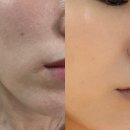 (주)이지바이오 제2공장 | 모공축소 관리에 포텐자 부산 센텀시티역 피부과 내돈내산 후기