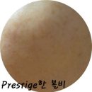 강남피부성형외과 네이버블로그