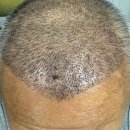 A Time for Choosing | KOREA VS TURKEY hair transplant : after 2 month review