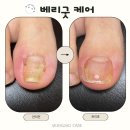 신호4길 26, (교현동) | [울산중구내성발톱] 자꾸만 파고드는 발톱 통증, 병원 수술 후 재발했다면? 베리굿케어 교정 후기!!