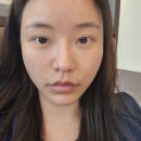 부산 서면피부과 팔자 쥬베룩볼륨 4cc 경과 솔직 후기