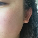 [횡성 상상뷰티] 흑자 레이저 후기 (내돈내산)