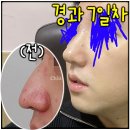 프로필성형외과의원 | 남자코수술, 꼭 필요한 변화만 담아 과하지 않고 자연스럽게!