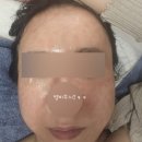 진의원 | 복합레이저 한관종 요철 기미 제거 후기 내돈내산#루비스타레이저 #실펌x #피코토닝레이저 #v레이저