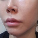 미모약국 | 힐로웨이브 팔자주름 필러 대신 선택한 리얼 후기