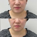 파발로59번길 | 경안동 피부관리 이프유스킨 경기광주본점 쏙프팅 후기! 이중턱 정리