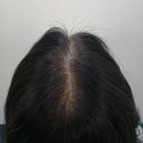 여성 정수리 두피 문신 실제 후기｜비 오는 날 더 비어 보이던 가르마, 이렇게 달라졌습니다