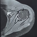 하단튼튼정형외과의원 | 어깨 회전근개 파열 치료후기