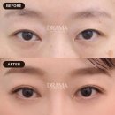 30대 중반, 눈가 노화의 시작? 매몰 쌍수, 눈매교정, 눈밑지우개 후기 | 드라마성형외과