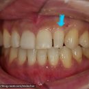 가람치과의원 | 앞니 왜소치를 레진으로 치료하는 이유 + 함박 눈~ 구경하세요. 성남 보존과 치과