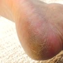 올바른 약국 | 발각질 연화제 스타킹 올 나가던 발 약국 크림 비교 후기