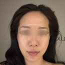 [압구정 피부관리] 루온에스테틱, 티리온X와 수기관리를 동시에!!