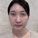 더400 | 대구 올타이트리프팅 400샷 후기｜통증 붓기 효과 솔직 리뷰